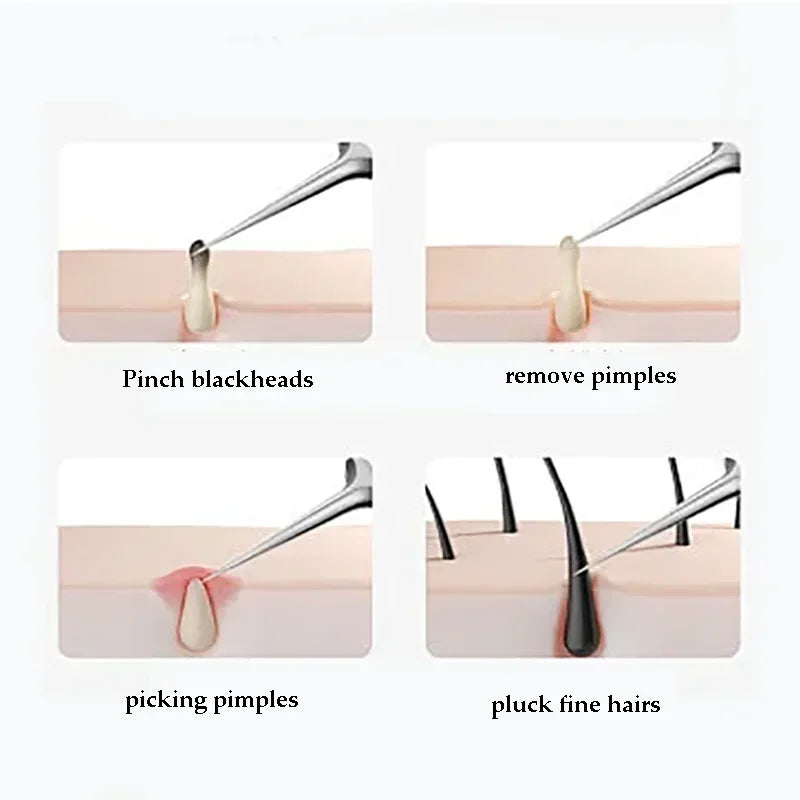 Ingrown Hair Tweezers And Blackhead Removal Needle Set